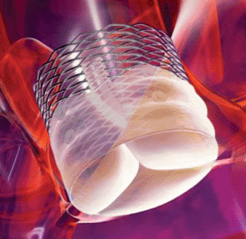 Imagen: El Sistema Valvular Lotus TAVR (Fotografía cortesía de Boston Scientific).